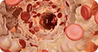 Hyperlipidemia