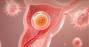  Premature ovarian failure