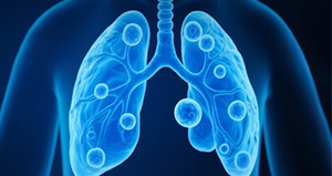 Interstitial Lung Disease